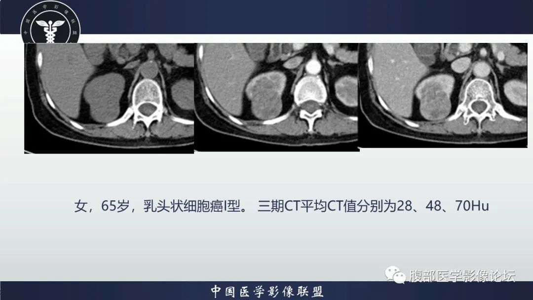 影像PPT - 【病例】肾脏副神经节细胞瘤1例影像分析-14
