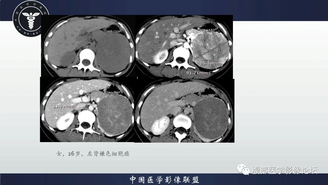 影像PPT - 【病例】肾脏副神经节细胞瘤1例影像分析-16