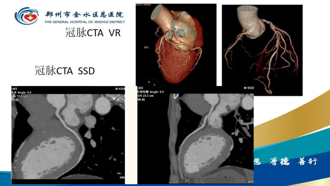 影像PPT - 【PPT】高端螺旋CT的临床应用-10