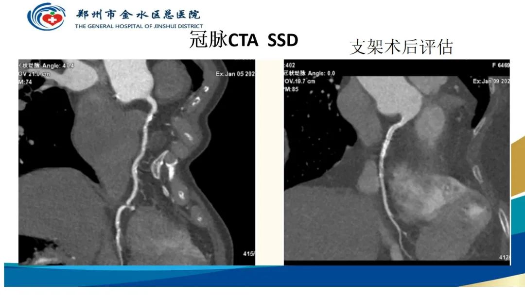 影像PPT - 【PPT】高端螺旋CT的临床应用-11