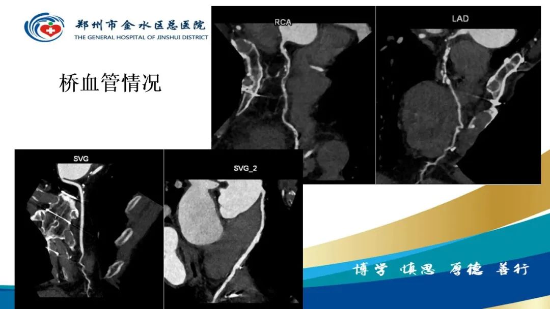 影像PPT - 【PPT】高端螺旋CT的临床应用-13