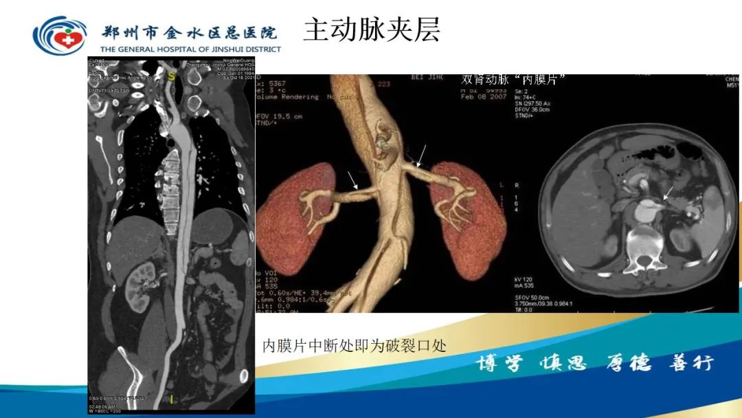 影像PPT - 【PPT】高端螺旋CT的临床应用-14