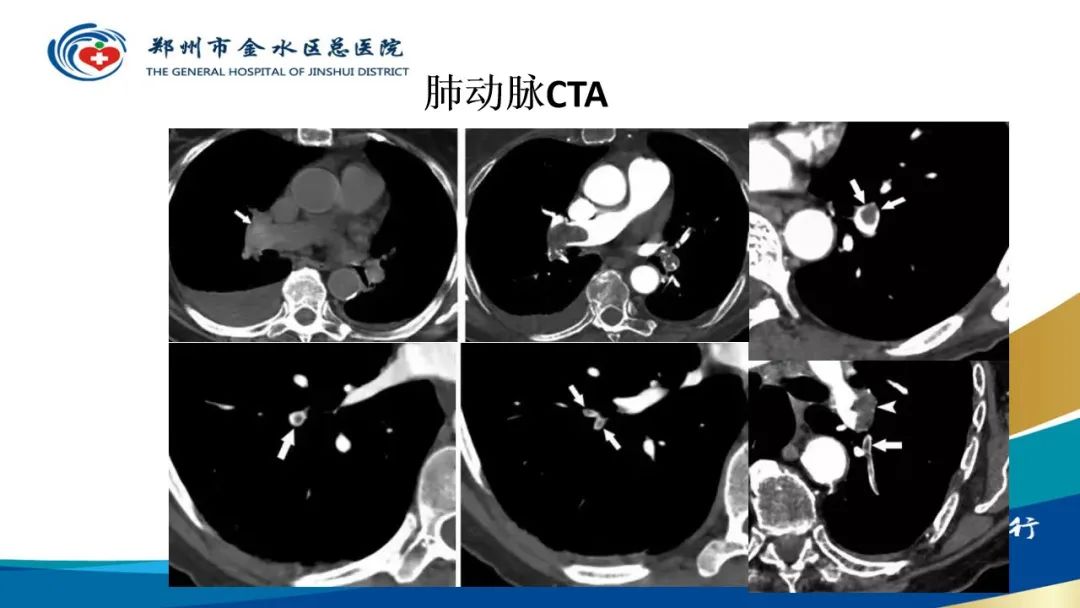 影像PPT - 【PPT】高端螺旋CT的临床应用-16