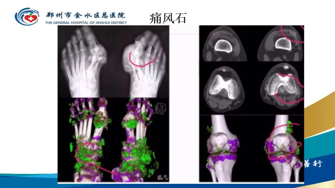 影像PPT - 【PPT】高端螺旋CT的临床应用-22