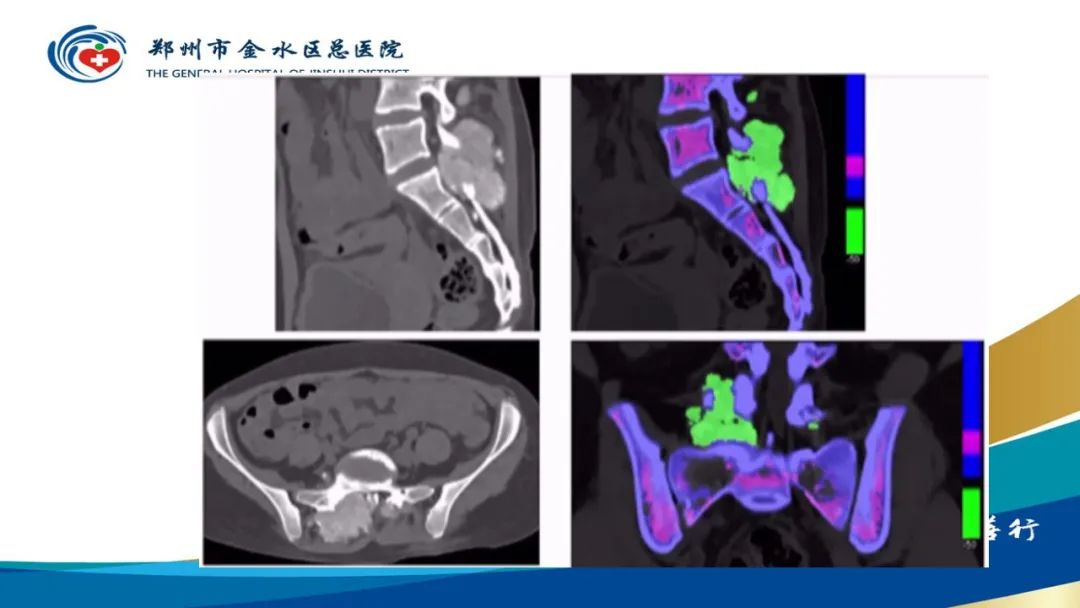 影像PPT - 【PPT】高端螺旋CT的临床应用-24