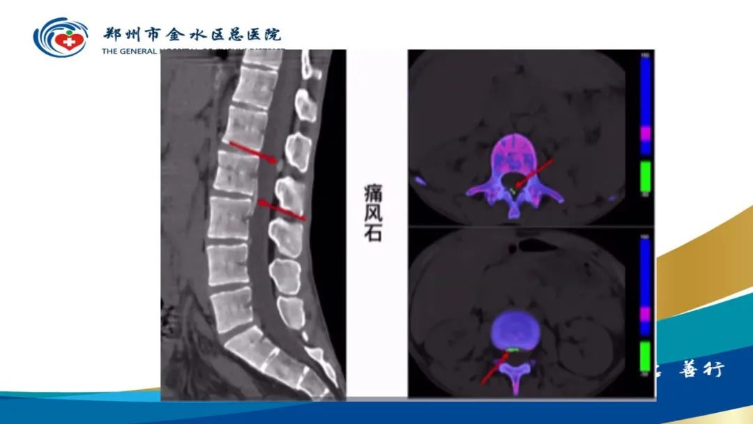 影像PPT - 【PPT】高端螺旋CT的临床应用-25