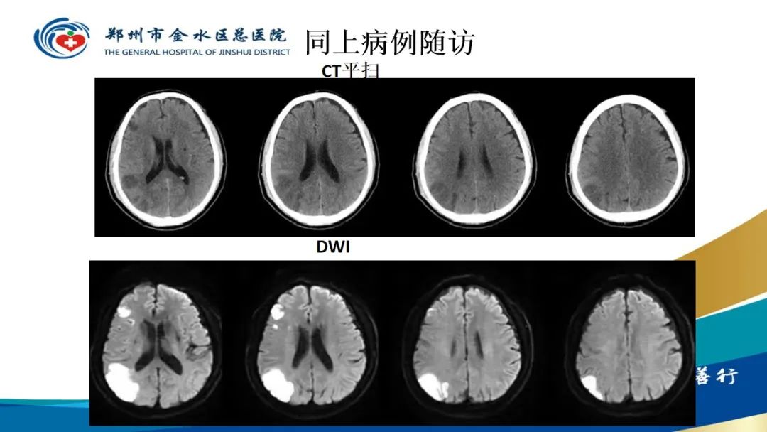 影像PPT - 【PPT】高端螺旋CT的临床应用-44