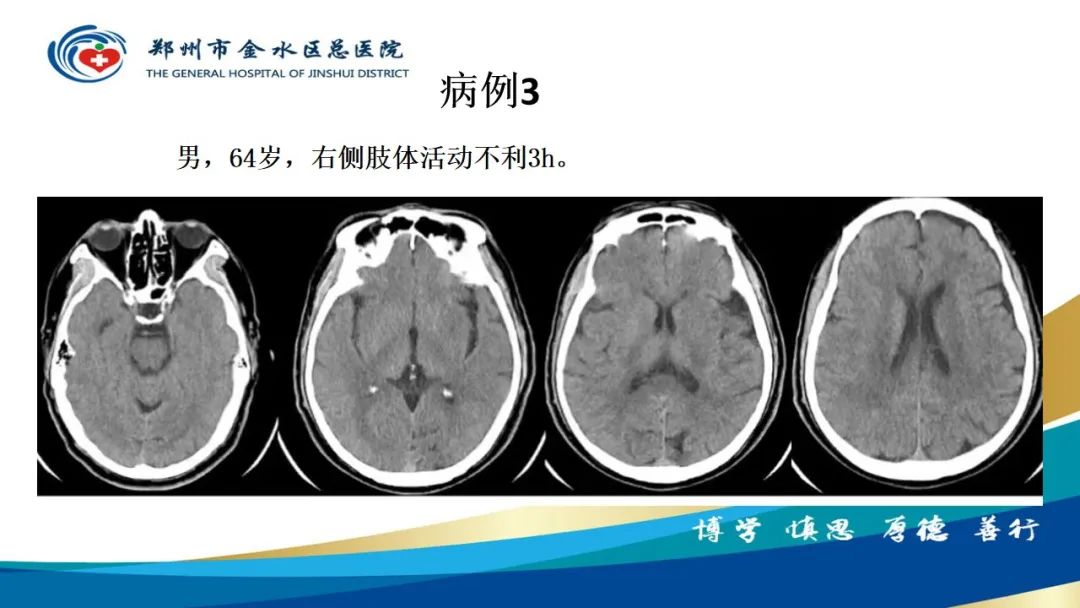 影像PPT - 【PPT】高端螺旋CT的临床应用-48