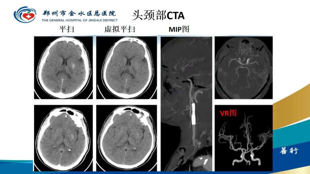 影像PPT - 【PPT】高端螺旋CT的临床应用-50