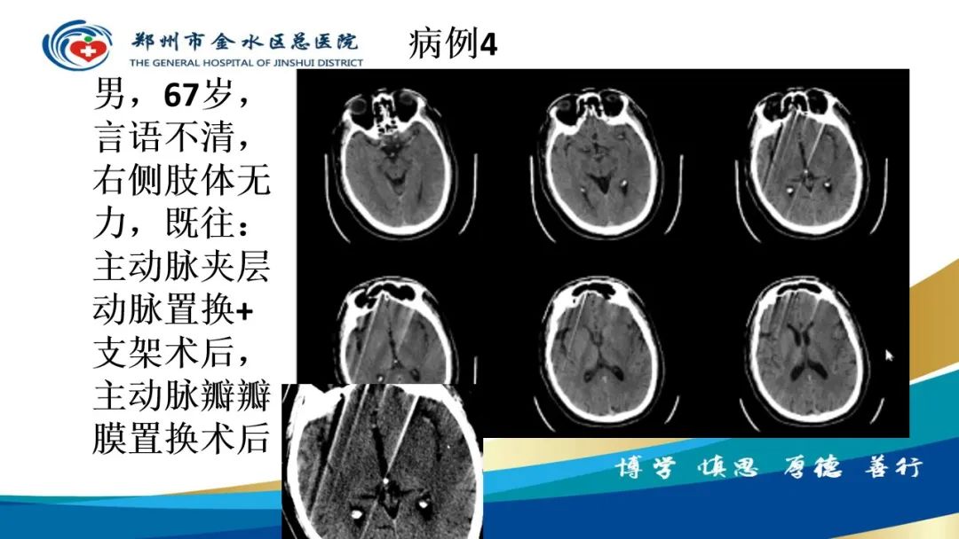 影像PPT - 【PPT】高端螺旋CT的临床应用-52