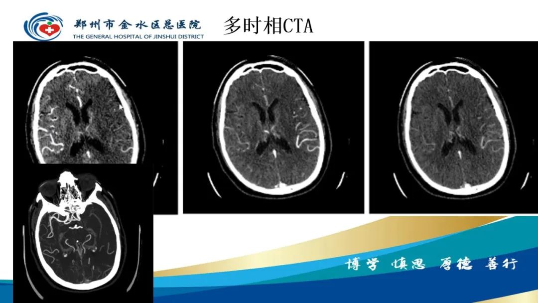 影像PPT - 【PPT】高端螺旋CT的临床应用-53
