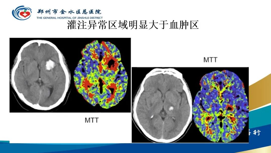 影像PPT - 【PPT】高端螺旋CT的临床应用-56