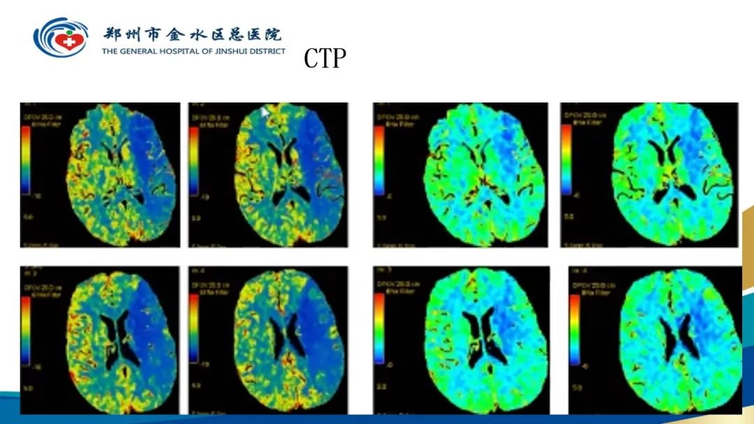 影像PPT - 【PPT】高端螺旋CT的临床应用-54