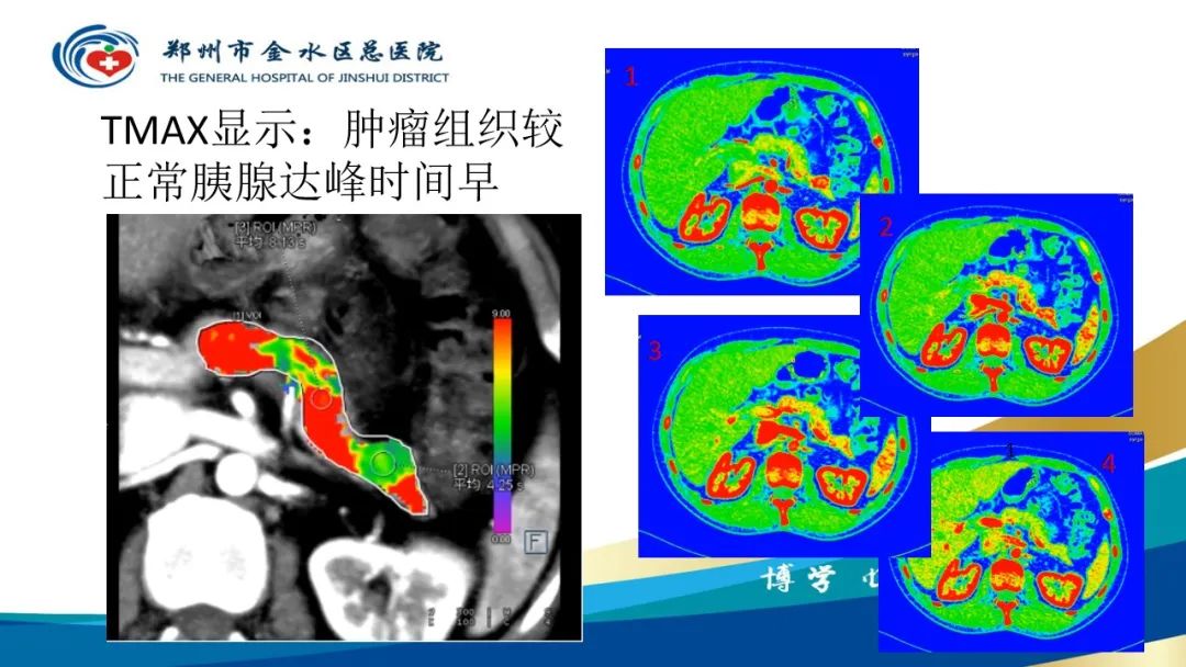 影像PPT - 【PPT】高端螺旋CT的临床应用-60