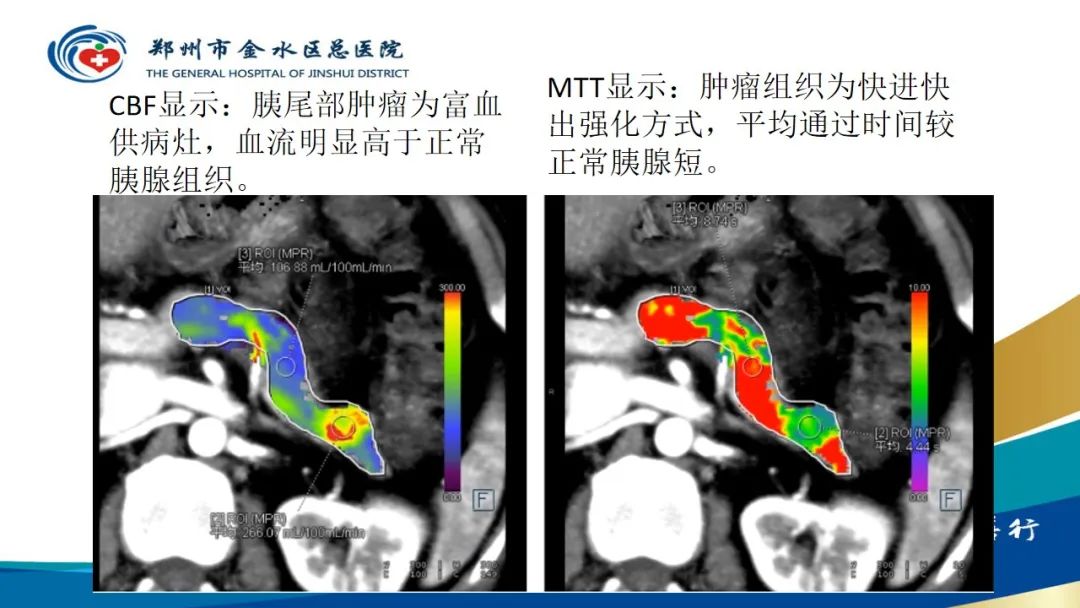 影像PPT - 【PPT】高端螺旋CT的临床应用-61