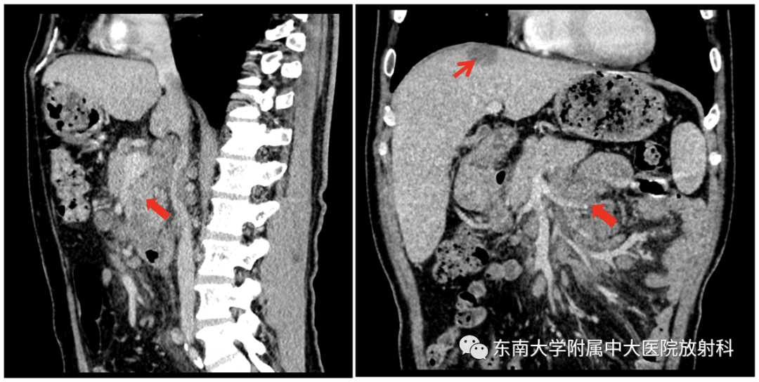 影像PPT - 【PPT】腹部多发淋巴结肿大影像诊断与鉴别-2