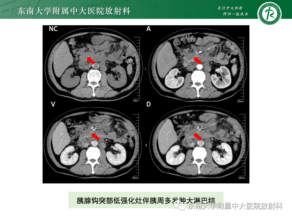 影像PPT - 【PPT】腹部多发淋巴结肿大影像诊断与鉴别-5