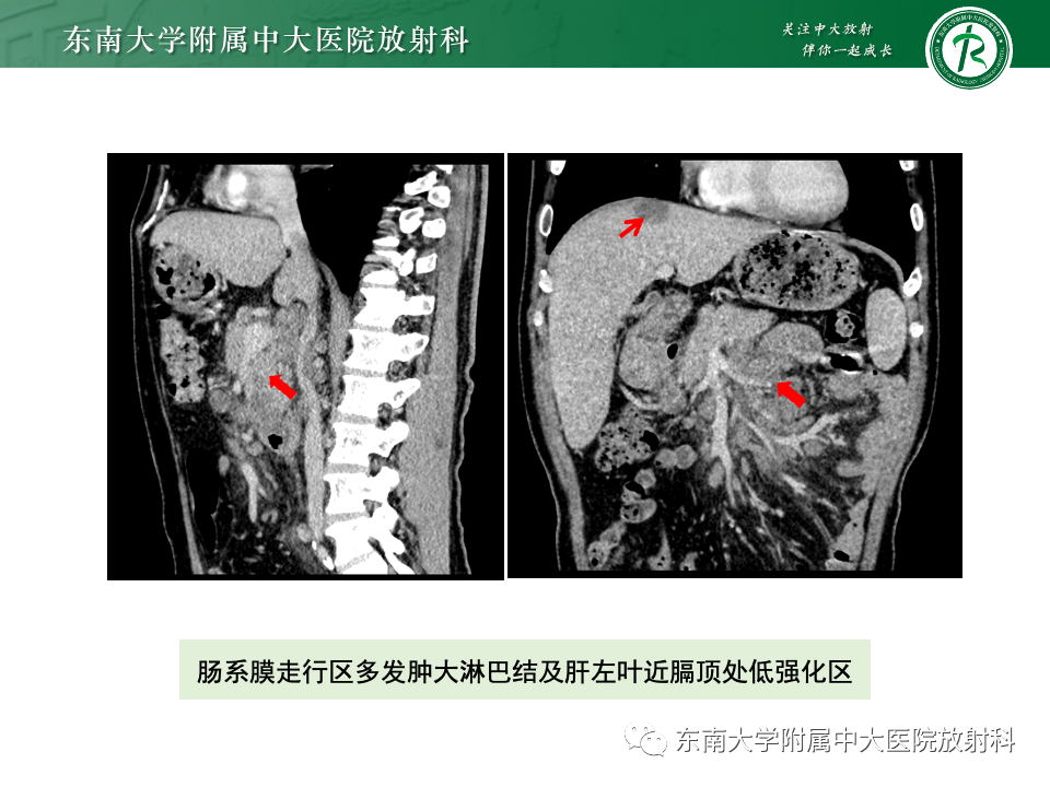 影像PPT - 【PPT】腹部多发淋巴结肿大影像诊断与鉴别-6