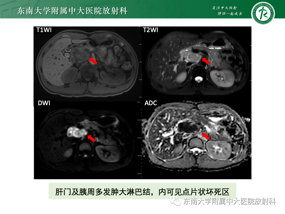 影像PPT - 【PPT】腹部多发淋巴结肿大影像诊断与鉴别-9