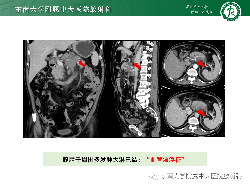 影像PPT - 【PPT】腹部多发淋巴结肿大影像诊断与鉴别-30
