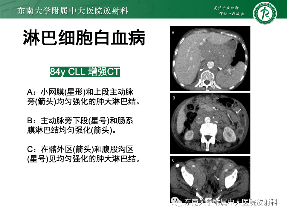 影像PPT - 【PPT】腹部多发淋巴结肿大影像诊断与鉴别-33
