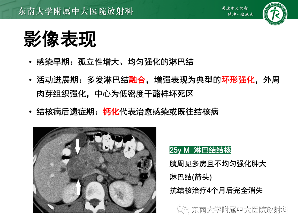 影像PPT - 【PPT】腹部多发淋巴结肿大影像诊断与鉴别-38