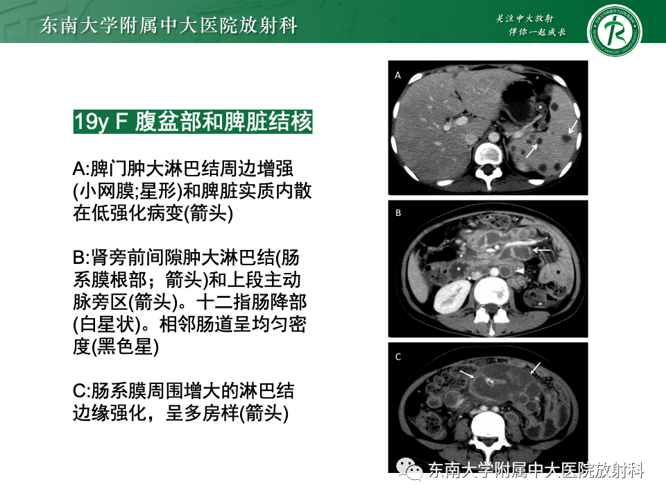 影像PPT - 【PPT】腹部多发淋巴结肿大影像诊断与鉴别-39