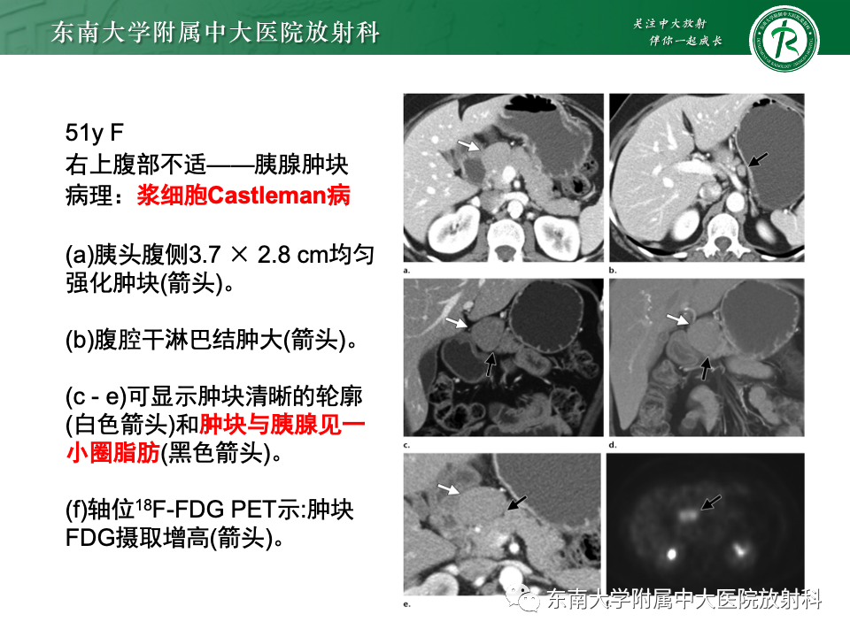 影像PPT - 【PPT】腹部多发淋巴结肿大影像诊断与鉴别-44