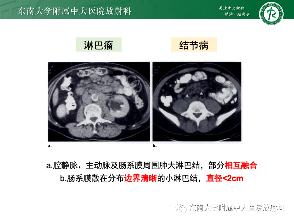 影像PPT - 【PPT】腹部多发淋巴结肿大影像诊断与鉴别-47