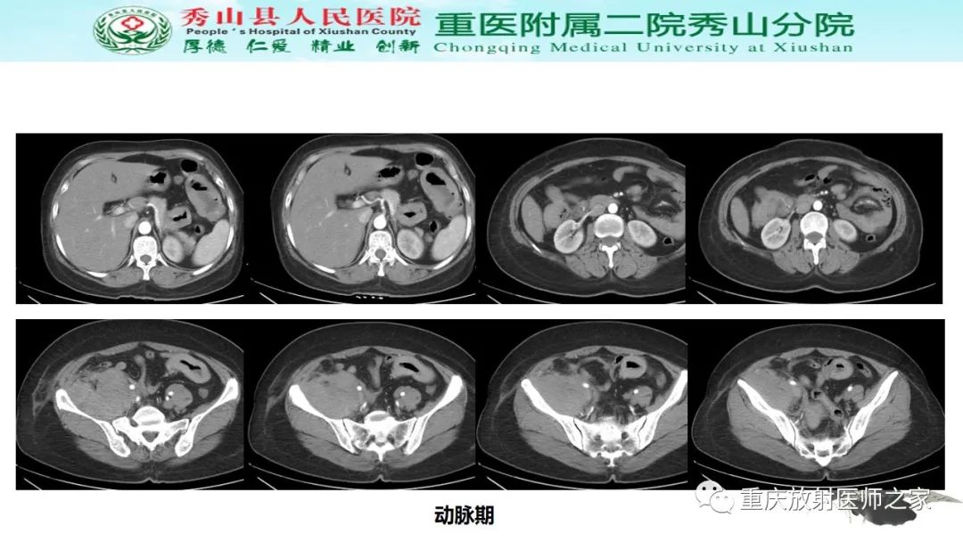 影像PPT - 【病例】胃肠道淋巴瘤1例CT影像-4