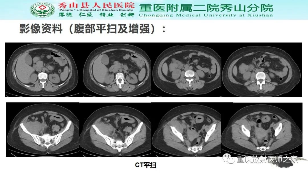 影像PPT - 【病例】胃肠道淋巴瘤1例CT影像-3
