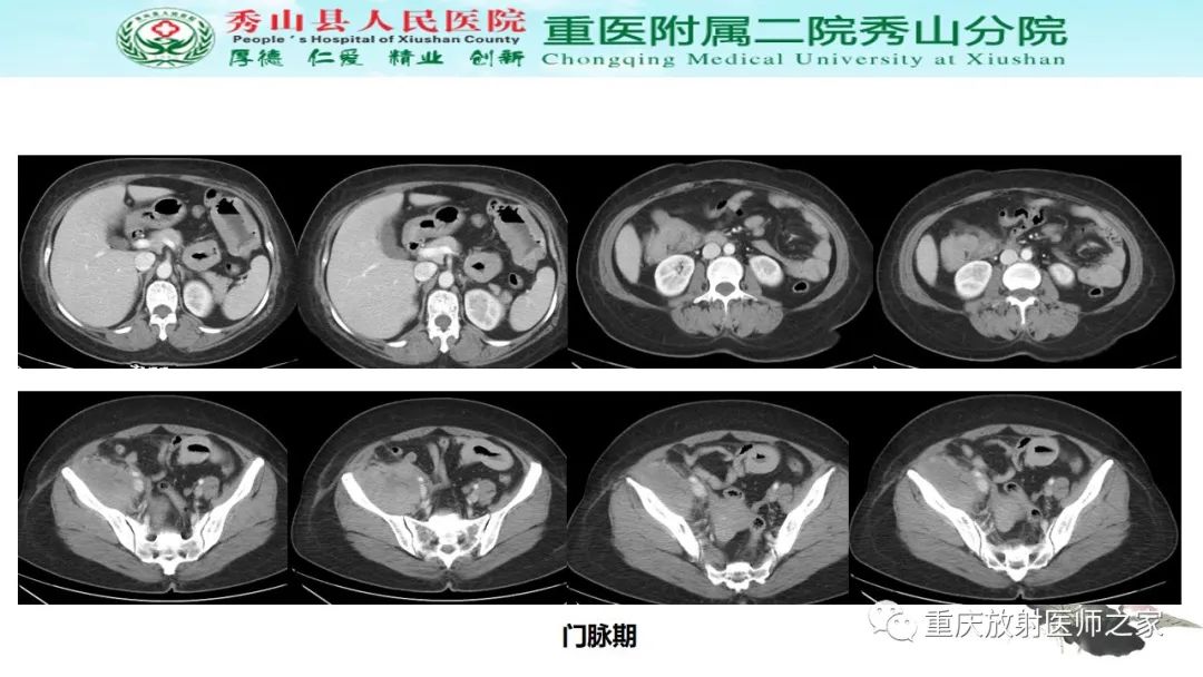 影像PPT - 【病例】胃肠道淋巴瘤1例CT影像-5