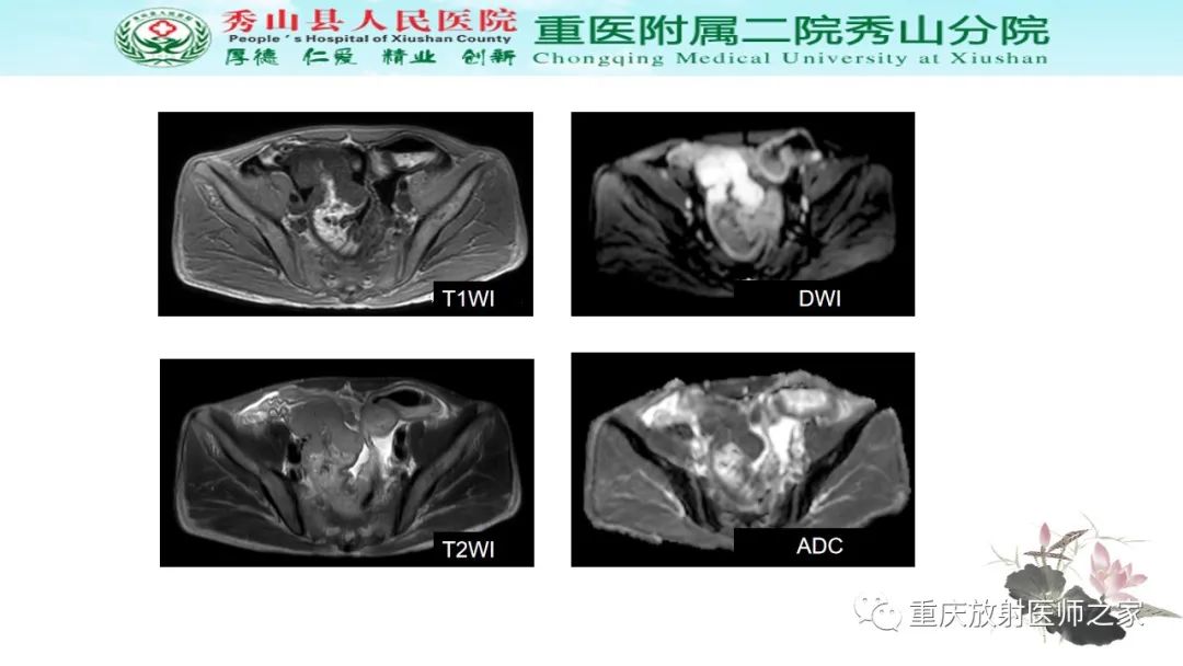 影像PPT - 【病例】胃肠道淋巴瘤1例CT影像-11