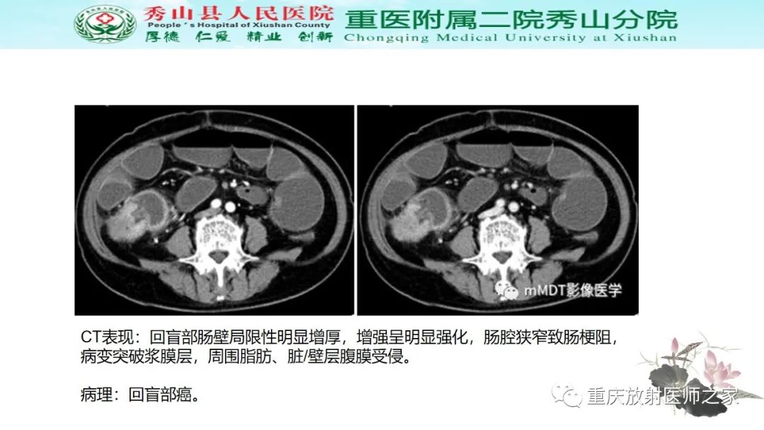影像PPT - 【病例】胃肠道淋巴瘤1例CT影像-13