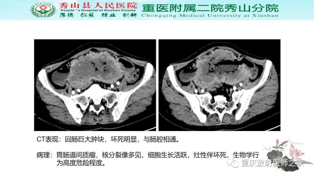 影像PPT - 【病例】胃肠道淋巴瘤1例CT影像-15