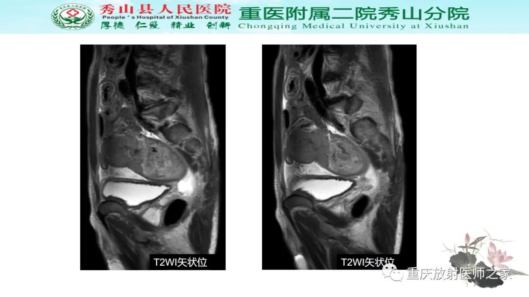 影像PPT - 【病例】胃肠道淋巴瘤1例CT影像-10