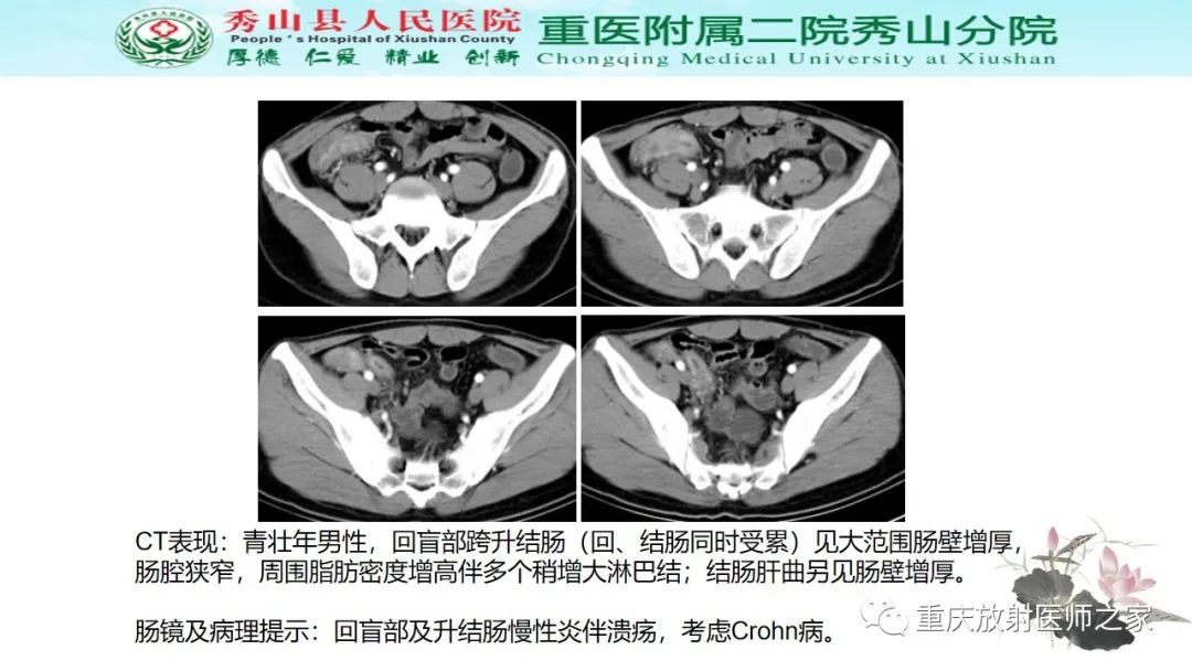 影像PPT - 【病例】胃肠道淋巴瘤1例CT影像-17