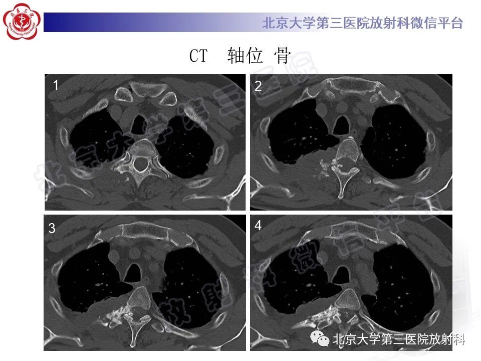 影像PPT - 【PPT】脊柱软骨肉瘤-3