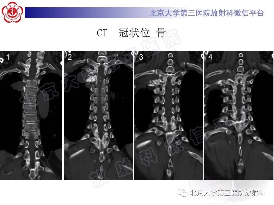 影像PPT - 【PPT】脊柱软骨肉瘤-4