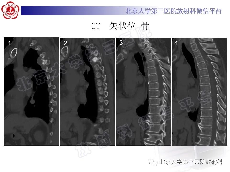 影像PPT - 【PPT】脊柱软骨肉瘤-5