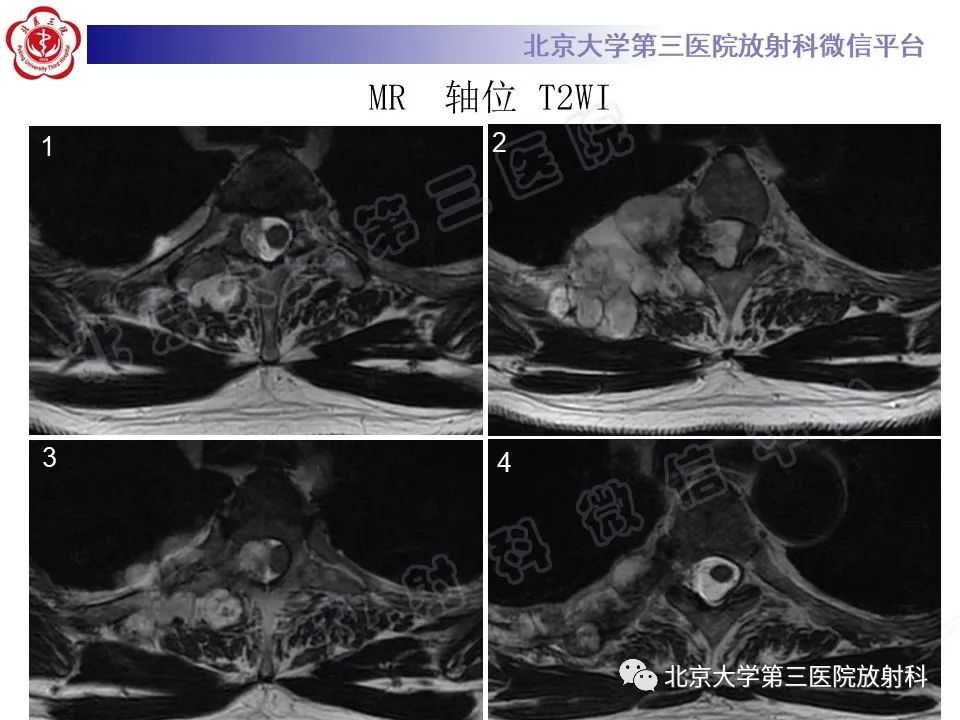 影像PPT - 【PPT】脊柱软骨肉瘤-6
