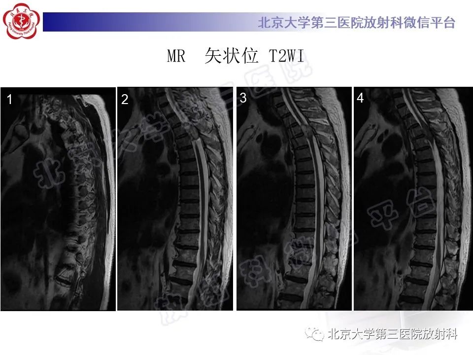 影像PPT - 【PPT】脊柱软骨肉瘤-7