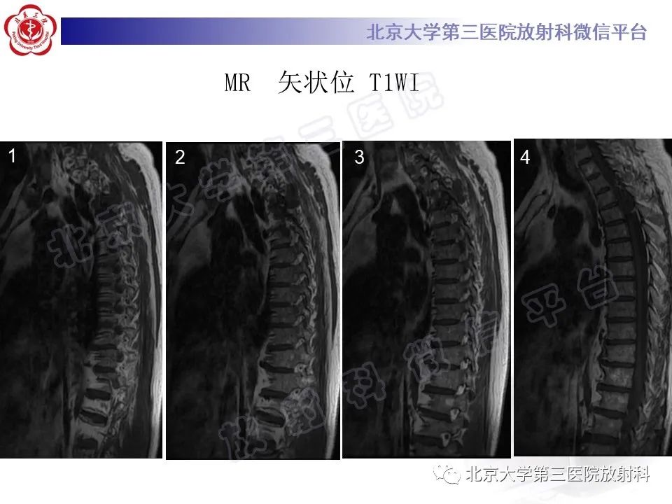 影像PPT - 【PPT】脊柱软骨肉瘤-8