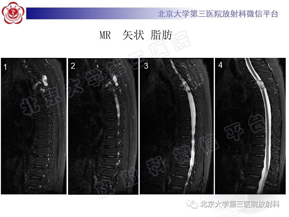 影像PPT - 【PPT】脊柱软骨肉瘤-9