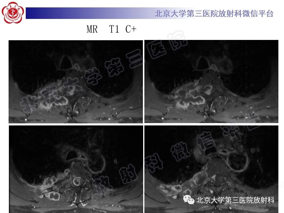 影像PPT - 【PPT】脊柱软骨肉瘤-10