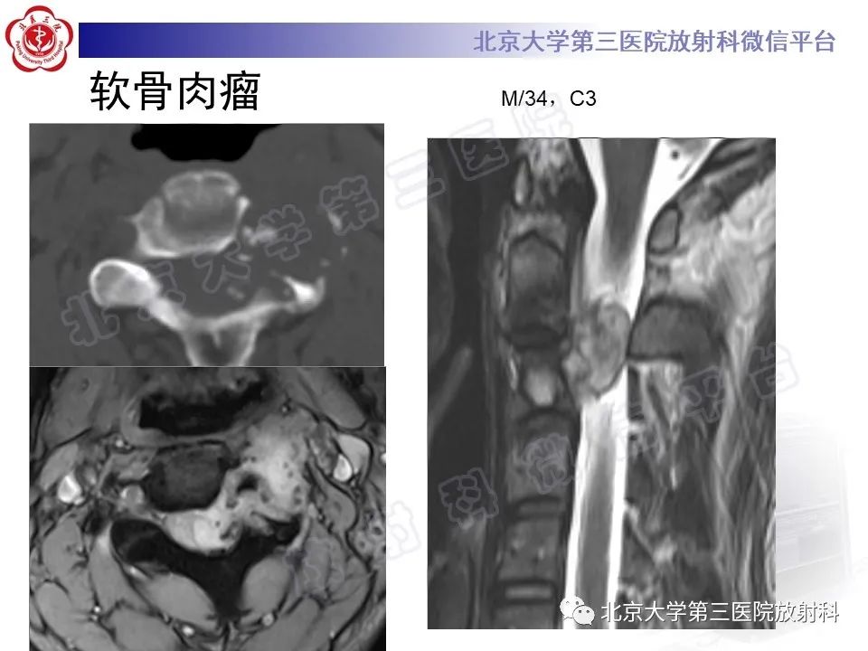 影像PPT - 【PPT】脊柱软骨肉瘤-21