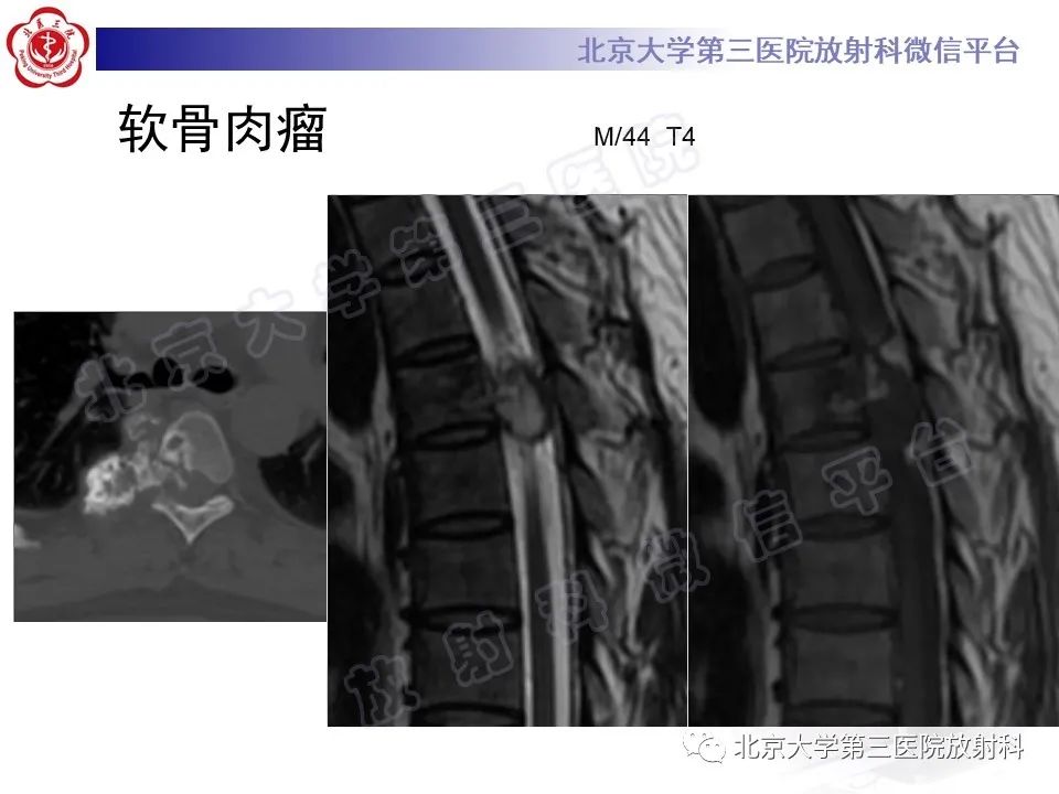 影像PPT - 【PPT】脊柱软骨肉瘤-23