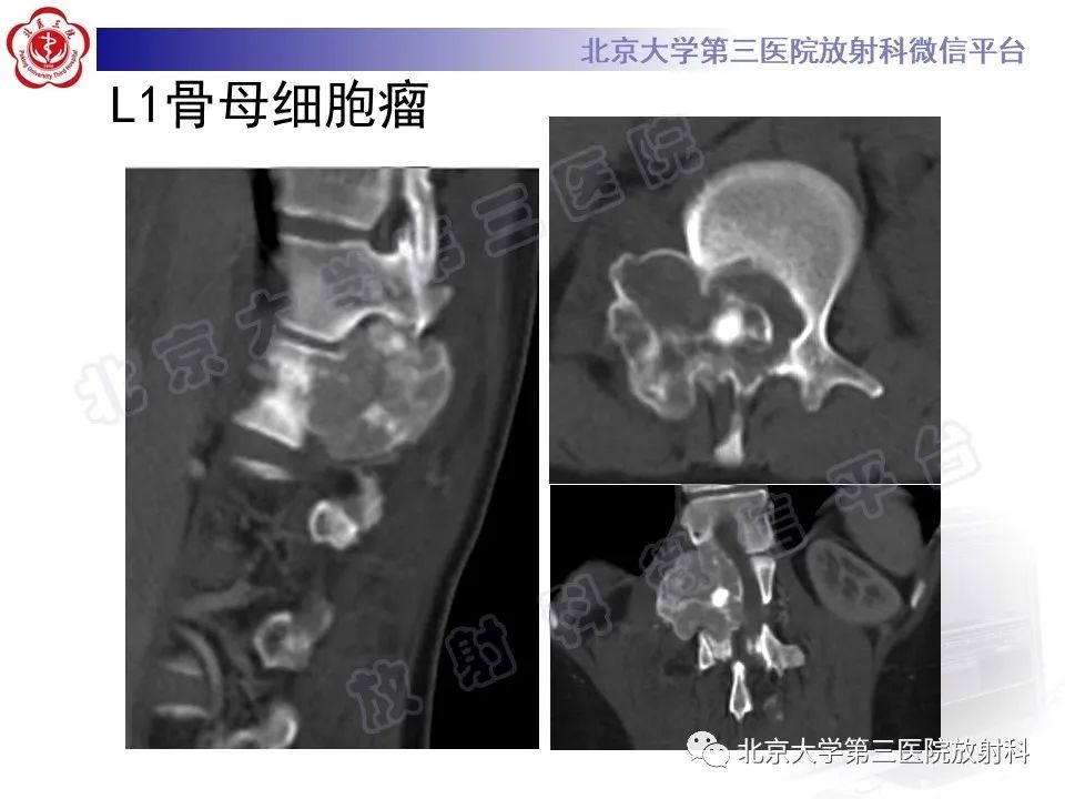 影像PPT - 【PPT】脊柱软骨肉瘤-25