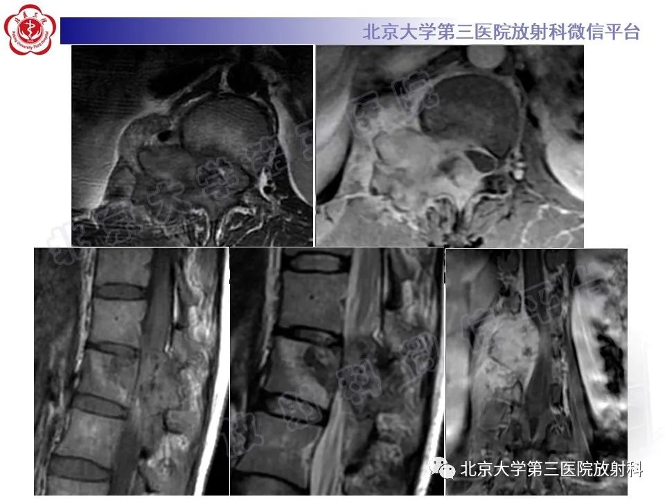 影像PPT - 【PPT】脊柱软骨肉瘤-26
