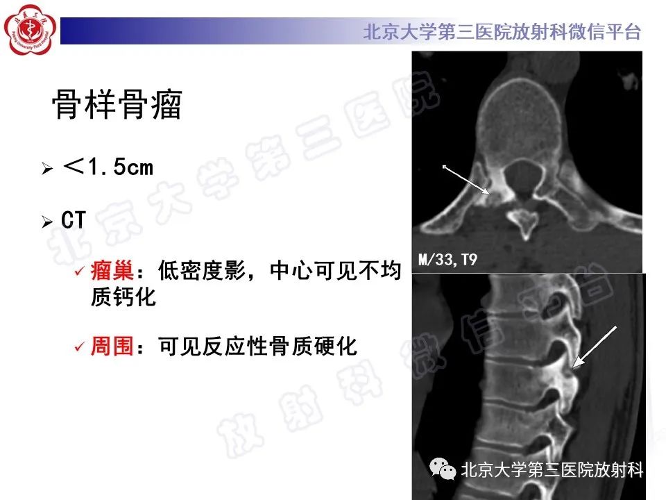 影像PPT - 【PPT】脊柱软骨肉瘤-27